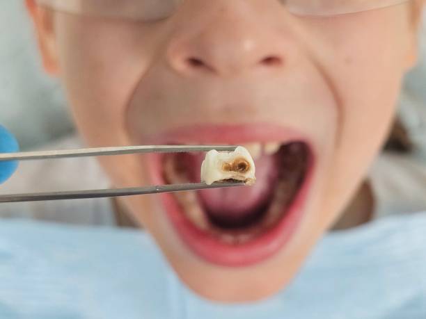 Best Emergency Root Canal Treatment in Lansing, MI